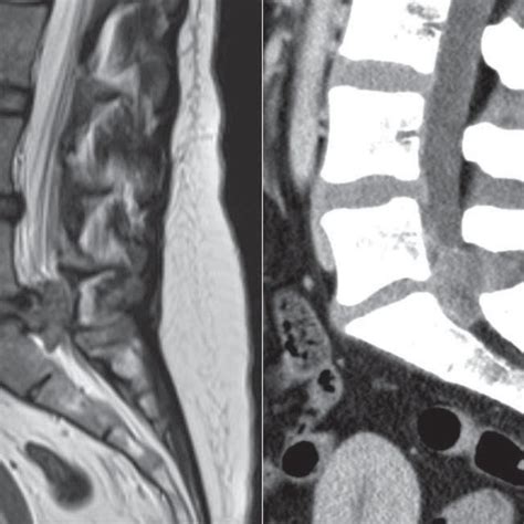 Herniated Nucleus Pulposus | Download Scientific Diagram