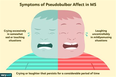 Pseudobulbar Affect in MS: Symptoms, Diagnosis, and Treatment