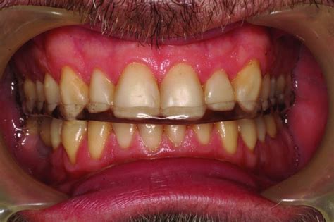 Occlusal Stabilisation Splints | Pocket Dentistry