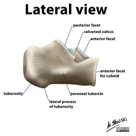 emDOCs.net – Emergency Medicine EducationCORE EM: Calcaneus Fractures - emDOCs.net - Emergency ...