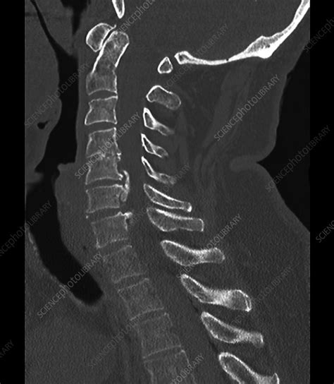 Osteoarthritis of the cervical spine, CT scan - Stock Image - C055/2197 - Science Photo Library