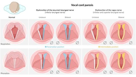 Vocal Cord Paramedian