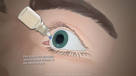 Effective Types of Eye Drops for Dry Eye Symptoms - Nashville ...