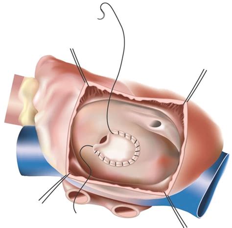 Cardiac Surgery - Minimally Invasive Atrial Septal Defect (ASD) Closure