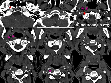 Vasa Vasorum | neuroangio.org