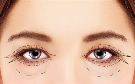 Tips for Successful Recovery After Eyelid Surgery