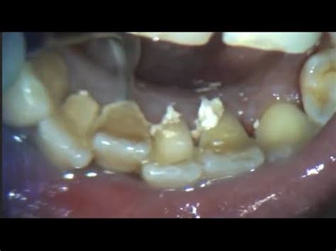 Plaque removed | Dental calculus | Long overdue plaque removal Before & After - YouTube