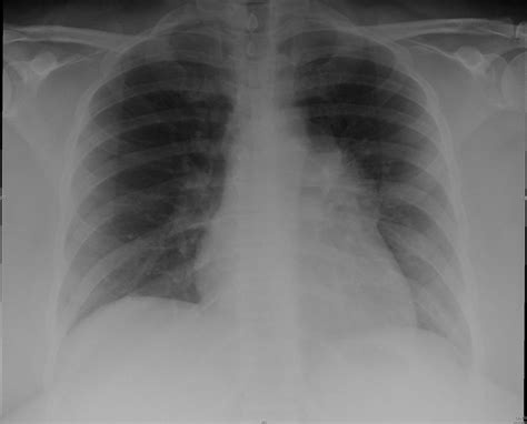 Thymoma Case 243 | A mediastinal mass is visible to the left… | Flickr