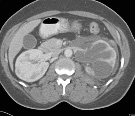 Pyonephrosis Left Kidney due to Obstructing Stone in Ureter - Kidney Case Studies - CTisus CT ...