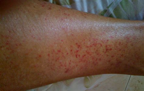 Photos of stasis dermatitis | Symptoms and pictures