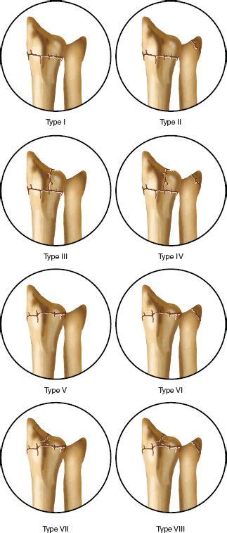 Fractures and Dislocations of the Wrist | Musculoskeletal Key