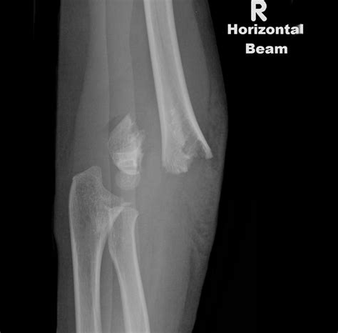 Avulsion fracture - wikidoc