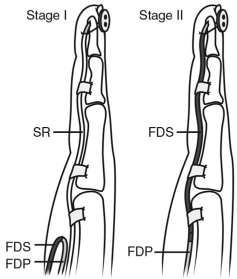 Fdp And Fds Tendons Anatomy - Soft Tissue Injuries Of The Hand ...