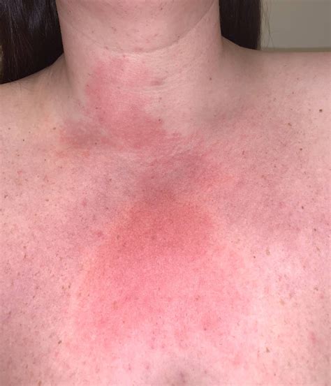 Skin reaction on my chest/neck. Any of you guys have reactions like this? : r/lupus