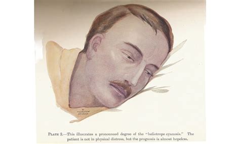 Symptoms · In-Flew-Enza: Spanish Flu in Columbia · Special Collections and Archives