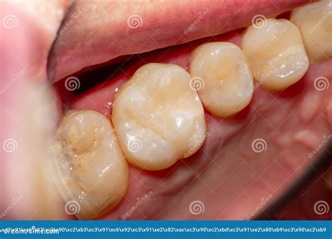 Treatment of Tooth Decay with Subsequent Filling with Photopolymer Material. Close-up, Macro ...