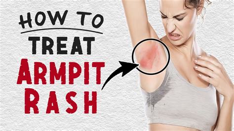 How To Treat Armpit Rash at Home | Home Remedies for Armpit Rash Treatment - YouTube