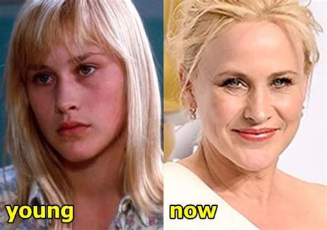 Patricia Arquette Plastic Surgery Before and After Photos