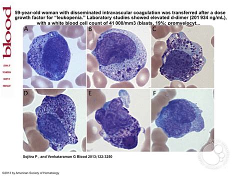 Chediak-Higashi–like granules within leukemic promyelocytes