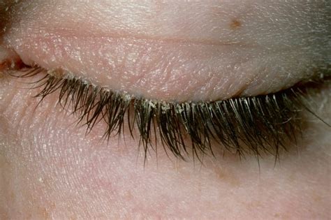 Seborrheic Blepharitis Treatment