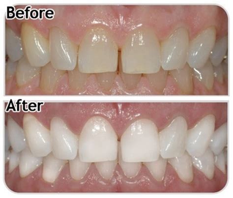 how to restore tooth enamel naturally - My Daily Magazine - Art, Design ...