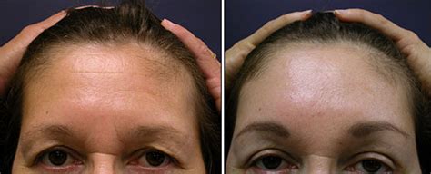 Forehead Lift: Brow Lift Scar After Pictures | Brow Lift Scar Treatment ...