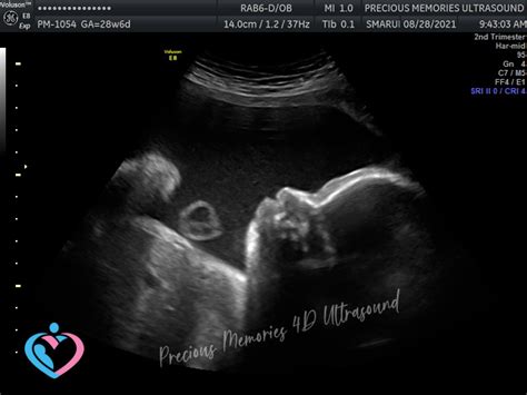 Pregnancy Ultrasound Image Gallery - 25 - 32 Weeks