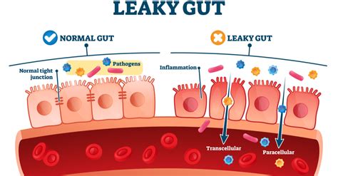 Leaky Gut; What Is It and how to fix it! | Higher Health