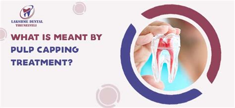 What is meant by Pulp Capping Treatment?