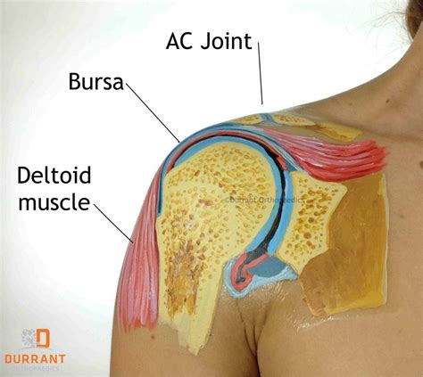 Shoulder Bursitis & Rotator Cuff Tears - Part Three