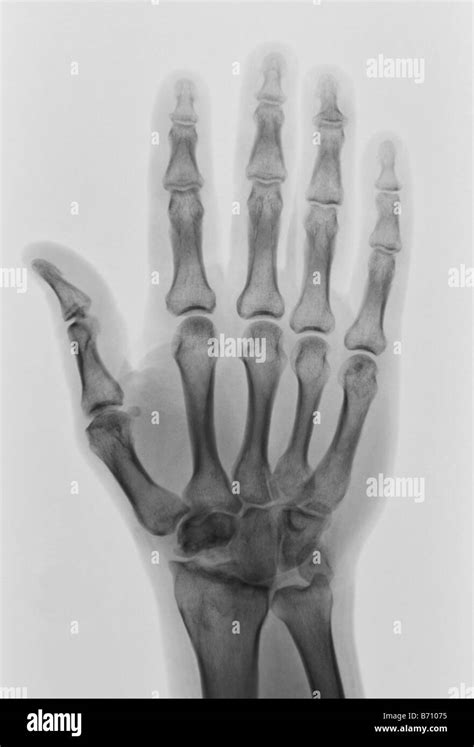 X ray normal hand hi-res stock photography and images - Alamy