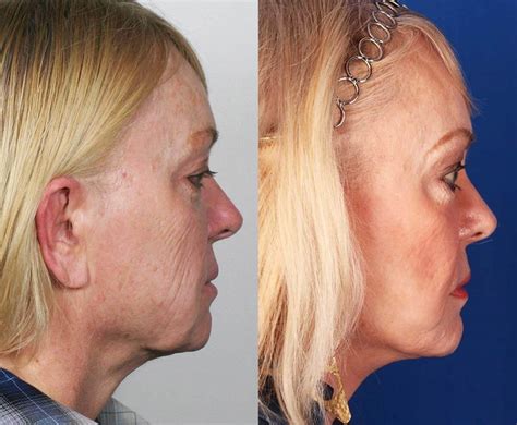 Contour Dermatology – Mini-facelift before and after