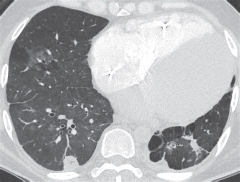 Pulmonary Vasculature Disease | Radiology Key