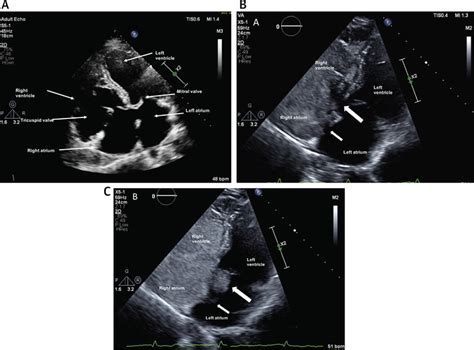 Ostium Primum on Transthoracic Echocardiogram | Download Scientific Diagram