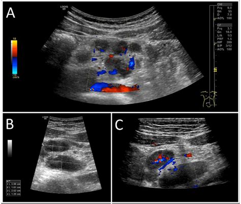 Abdominal ultrasound examination reveals multiple enlarged mesenteric... | Download Scientific ...