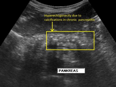 Chronic pancreatitis ultrasound - wikidoc