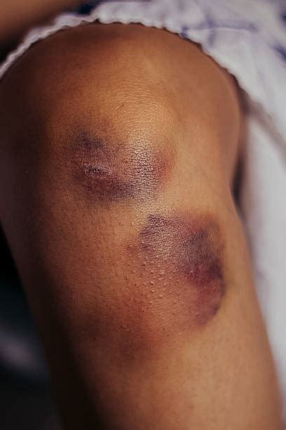 Best Bruise Stock Photos, Pictures & Royalty-Free Images - iStock