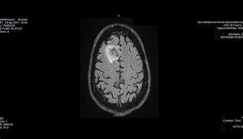 Brain Tumor Color Mri