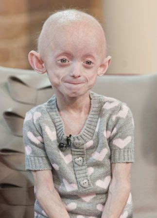 progeria | Definition, Types, Symptoms, & Facts | Britannica.com