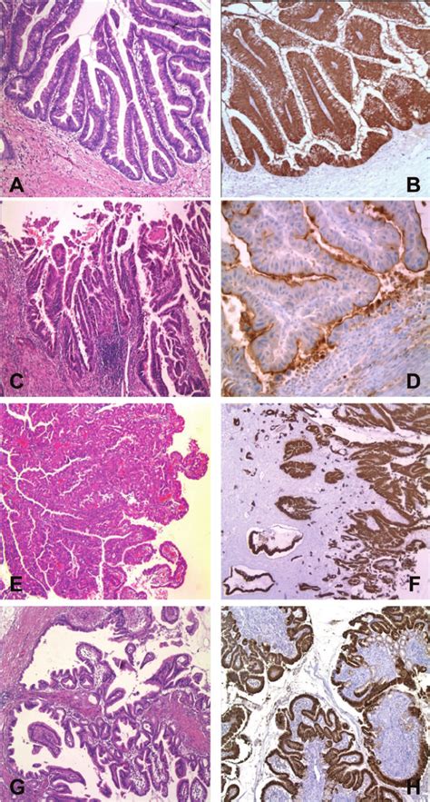 Histopathological subtypes of intraductal papillary mucinous neoplasm... | Download Scientific ...