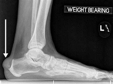 Gout and Calcium Pyrophosphate Deposition Disease