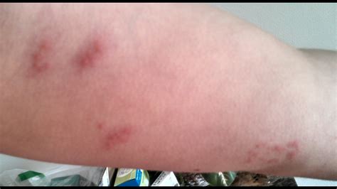 Bed Bug Rash Spreading | BangDodo