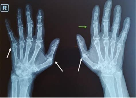 Hands Deformity in a Patient with IgA Vasculitis. - Abstract - Europe PMC