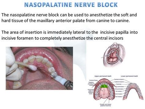 Dentaltown - The nasopalatine nerve block can be used to anesthetize the soft and hard tissue of ...