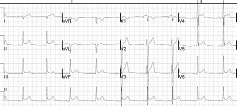 Benign Early Repolarisation • LITFL • ECG Library Diagnosis