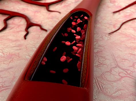 IVC Filter Lawsuits - Blood Clot Filter Recalls | Saunders & Walker P.A.