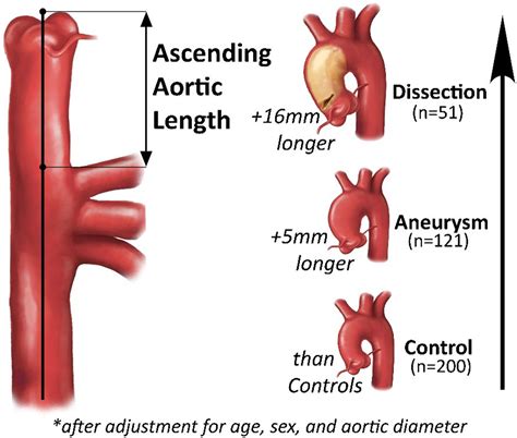 Ascending Aortic Length and Its Association With Type A Aortic Dissection | Journal of the ...