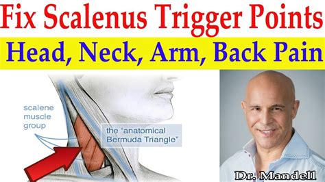 Fix Scalenus Trigger Points! Quick Relief to Head, Neck, Arm, Upper Back Pain - Dr Alan Mandell ...