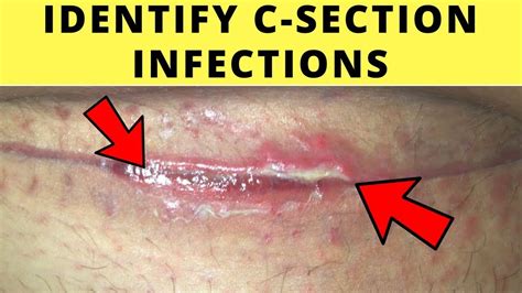 How to Get Rid of Yeast Infection on C-Section Scar - MyHealthGeek