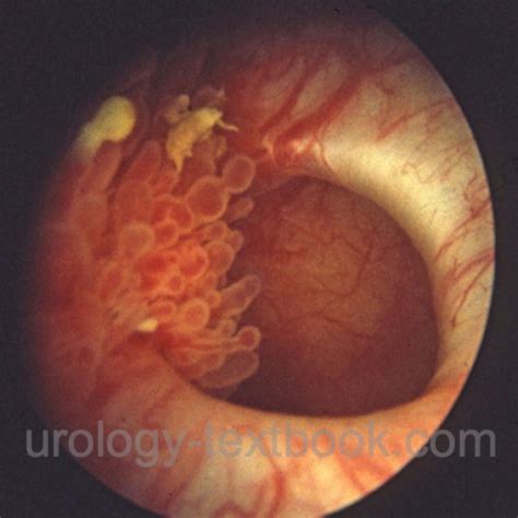 Bladder Diverticulum: Etiology, Diagnosis and Treatment